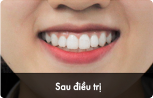 hieu_qua_sau_1