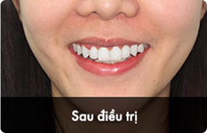 hieu_qua_sau_2