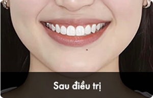 hieu_qua_sau_3