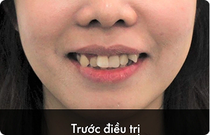 hieu_qua_truoc_2