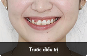 hieu_qua_truoc_3